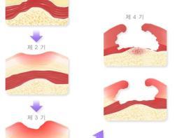 [인권문자] 욕창은 인권에 난 구멍  기사 이미지