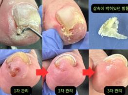 발톱 하나가 어르신의 걸음을 바꿉니다 기사 이미지
